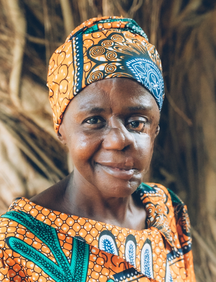 MSF Joins Noma Survivors In Celebrating Inclusion In WHO Neglected 